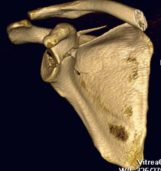 Glenoid Fracture 2